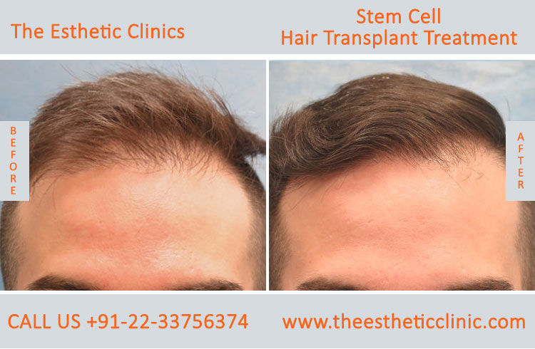 Stem Cell Hair Transplant Treatment before after photos in mumbai india